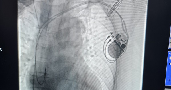 Có những rào cản nào khi sử dụng máy tạo nhịp tim vĩnh viễn?
