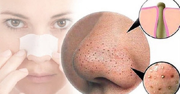 Làm thế nào để ngăn ngừa mụn đầu đen ở mũi tái phát?
