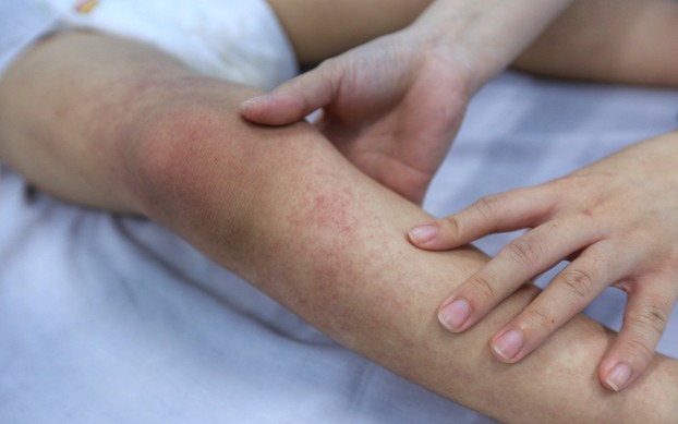 Tự điều trị sốt xuất huyết tại nhà, cô gái 20 tuổi tử vong