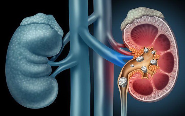 Bác sĩ ơi: Phát hiện sớm và tầm soát ung thư thận như thế nào?