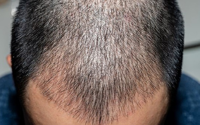 Chữa hói đầu hiệu quả bằng cấy tóc tự thân cho cả nam và nữ giới