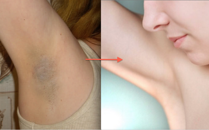 thâm nách: tin tức, hình ảnh, video, bình luận mới nhất