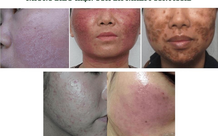 dam nó kem trộn