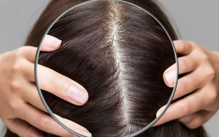 Rụng tóc hói đầu là gì 10 điều bạn nên biết về chứng bệnh mất thẩm mỹ  này