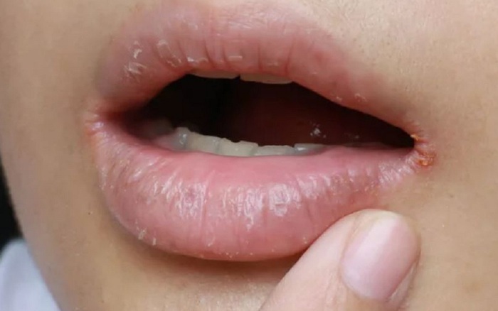 Góc miệng bị nứt có thể là triệu chứng của viêm môi, cách nào để ...