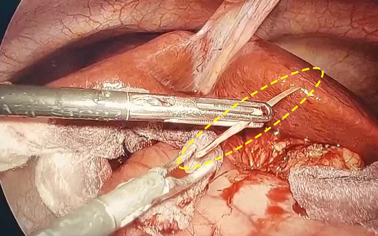 Sau 1 tháng ăn cá, nam thanh niên được phát hiện áp xe tụy do xương cá