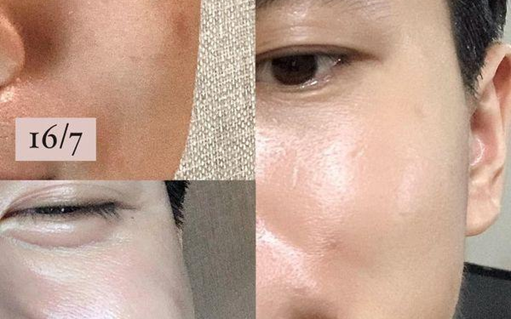 Hướng dẫn sử dụng serum trị nám VI Derm Dark Spot Lifting đạt hiệu quả