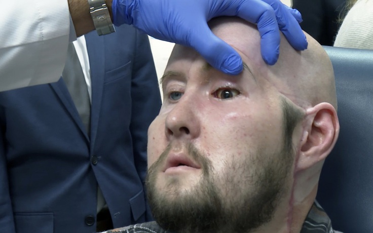Bác sĩ Mỹ thực hiện ca cấy ghép toàn bộ mắt đầu tiên trên thế giới