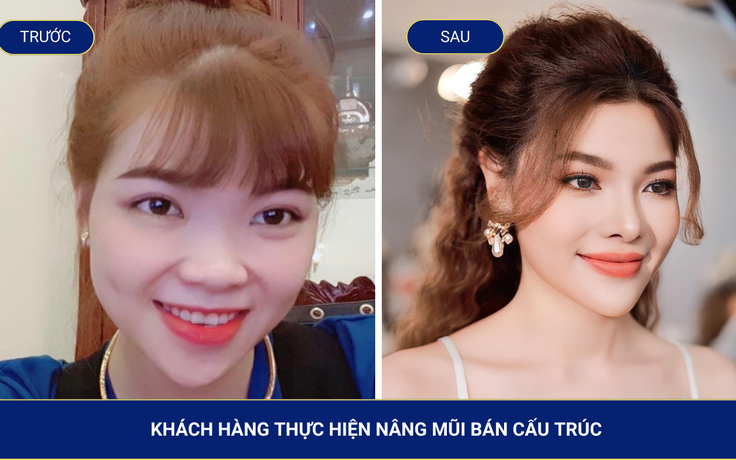 Nâng mũi bán cấu trúc giữ được bao lâu?