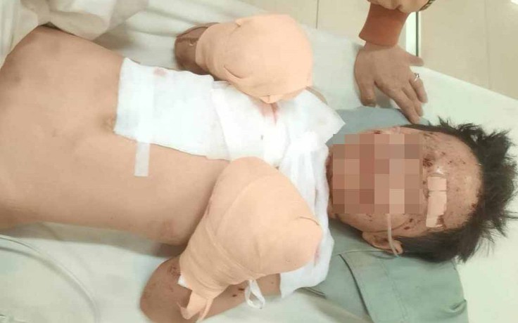 Đắk Lắk: Làm rõ nghi vấn nổ pháo tự chế khiến bé trai mất hai bàn tay