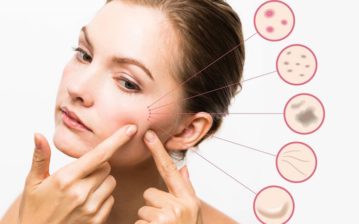 Phục hồi làn da mụn và kích ứng sau kỳ nghỉ tết dài Phục hồi làn da mụn và kích ứng sau kỳ nghỉ tết dài
