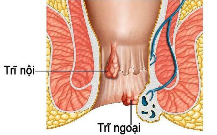 Cấp cứu nữ bệnh nhân mất 2/3 lượng máu cơ thể do búi trĩ chảy máu