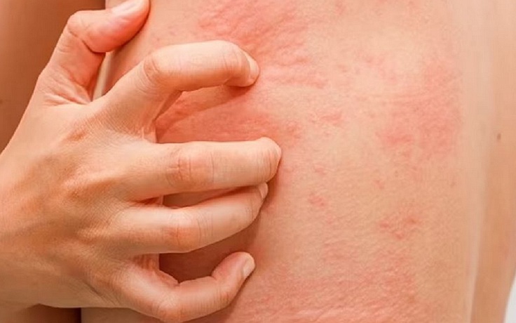 Làm sao để biết món mình vừa ăn có gây dị ứng hay không? Làm sao để biết món mình vừa ăn có gây dị ứng hay không?