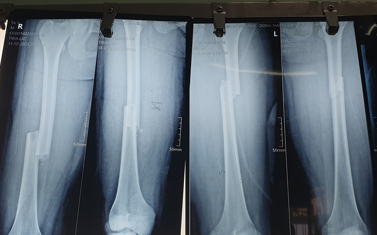 Nối xương đùi cả 2 chân cùng lúc cho bệnh nhi bị đa chấn thương