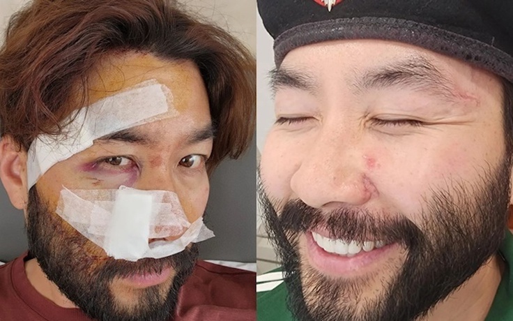 Sức khỏe của nam MC Hàn Quốc sau vụ tai nạn giao thông ở Việt Nam