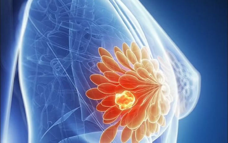 Loại thuốc có sẵn giúp giảm đến 25% nguy cơ tái phát ung thư vú