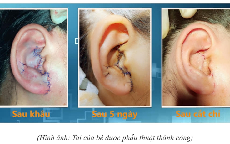 Bé gái bị đứt lìa vành tai do tai nạn giao thông