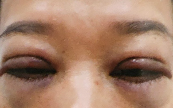 Nữ bệnh nhân ở TP.HCM đi cấp cứu trong đêm sau thẩm mỹ cắt bọng mắt