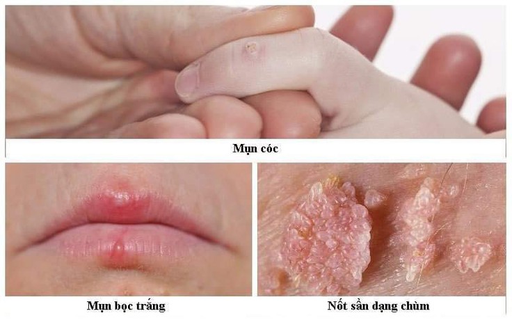 Làm sao để tránh những căn bệnh ngoài da dễ lây khi sống tập thể? Làm sao để tránh những căn bệnh ngoài da dễ lây khi sống tập thể?