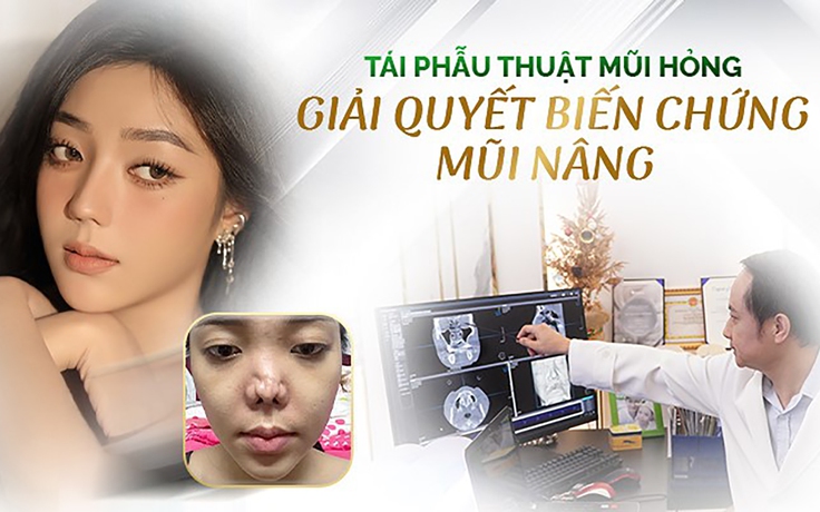 Tái phẫu thuật mũi hỏng - giải quyết biến chứng nâng mũi