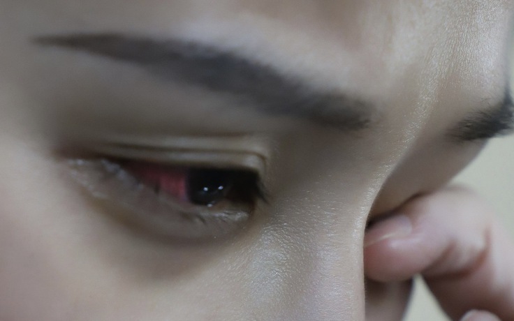 Biến thể vi rút coxsackie A24 gây đau mắt đỏ nguy hiểm như thế nào?