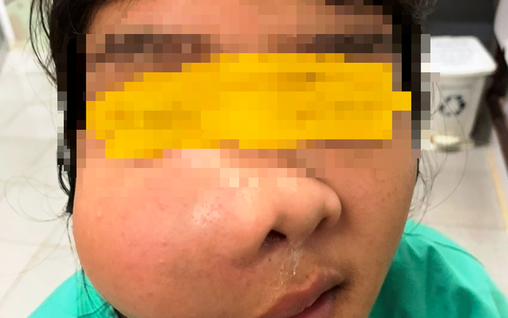 Bệnh nhân mang khối u vùng mặt to như quả cam, gây nghẹt mũi, khó thở