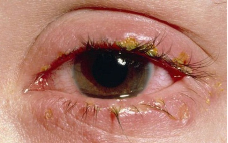 Đau mắt đỏ do vi rút adeno và entero có nguy hiểm, có cần nhỏ thuốc ngừa?