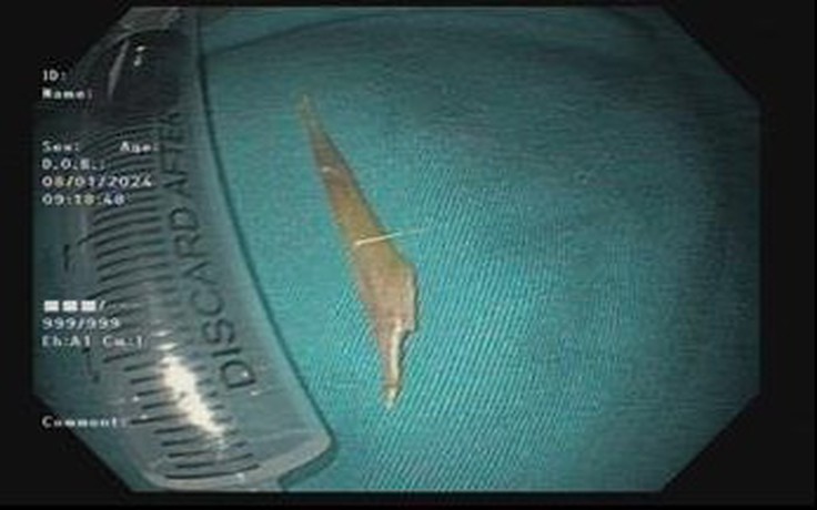 Đồng Nai: Nội soi lấy ra xương cá mắc trong dạ dày bệnh nhân