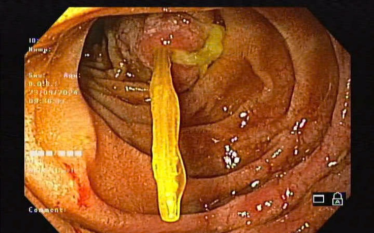 Đau bụng, nặng ngực đi khám mới phát hiện tăm tre đâm thủng tá tràng
