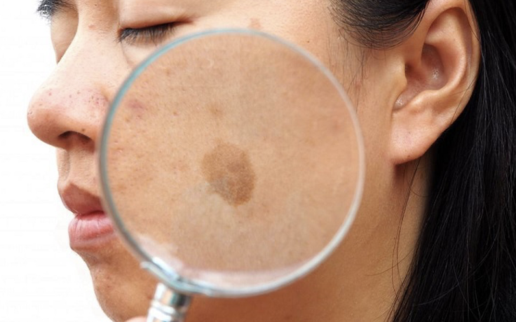 Sạm, nám lâu năm có điều trị 'dứt điểm' an toàn được không?