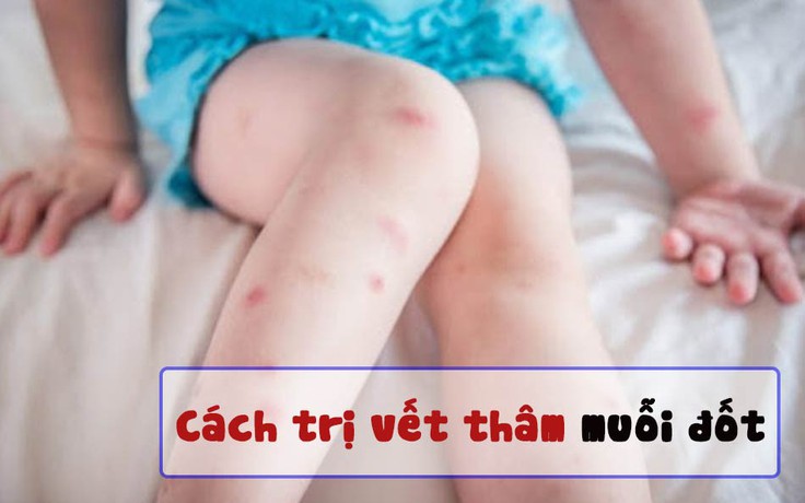 Top 5 kem trị sẹo thâm do côn trùng cắn được tìm mua nhiều hiện nay