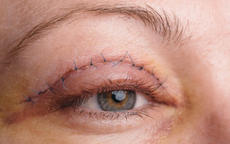 Học bí kíp chăm sóc sau cắt mí mắt từ chuyên gia