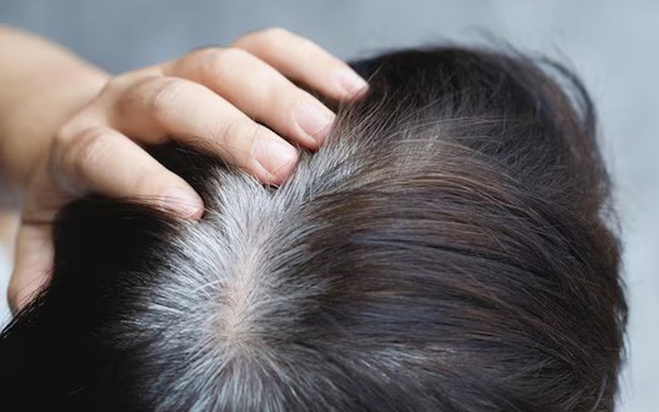 Tóc bạc sớm có liên quan đến bệnh?