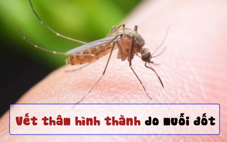 Bật mí cách trị sẹo thâm ở chân do muỗi đốt hiệu quả ngay tại nhà