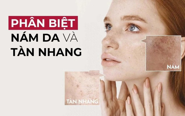 Đừng nhầm lẫn nữa! 5 dấu hiệu phân biệt nám và tàn nhang