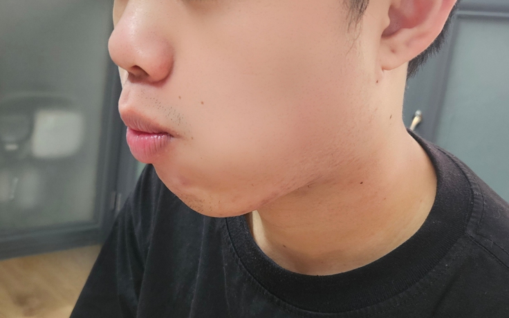 Hay nhai một bên khi ăn: Tưởng vô hại nhưng… nhiều tác hại!