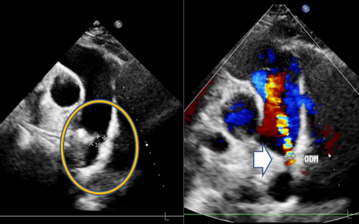 Bàng hoàng phát hiện dị tật tim bẩm sinh sau hơn 30 năm sống khỏe mạnh