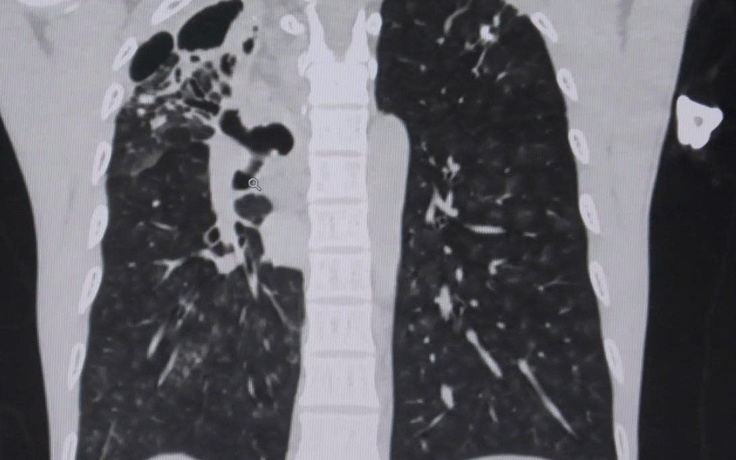 Người đàn ông ho ra cả chén máu vì vỡ mạch máu phế quản