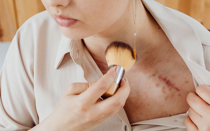 Cuộc chiến với sẹo: Nắm ‘vũ khí’ khoa học chống sẹo sau phẫu thuật