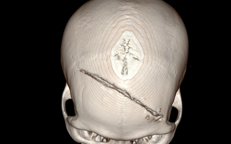 Vỡ sọ, dập não sau xô xát, nam thanh niên được cứu sống đầy ngoạn mục