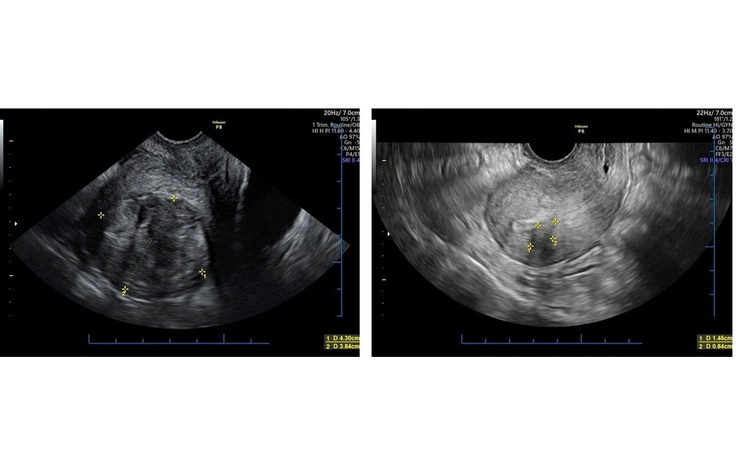 Điều trị u tử cung không xâm lấn, bảo tồn chức năng sinh sản