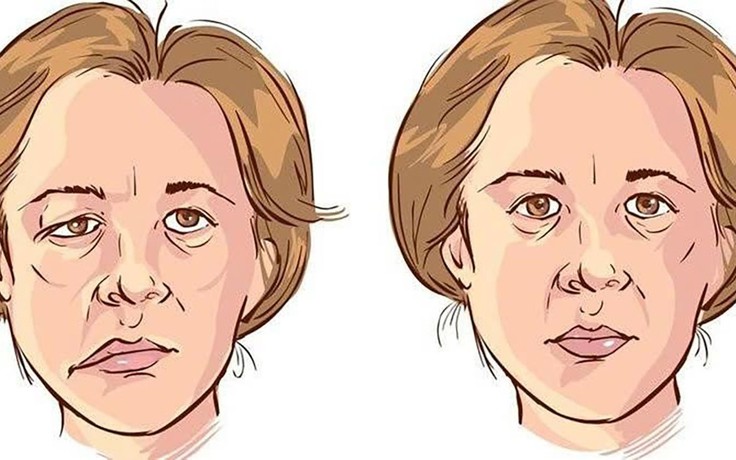 Hành trình tìm lại nụ cười sau hơn 1 năm bị co giật nửa mặt