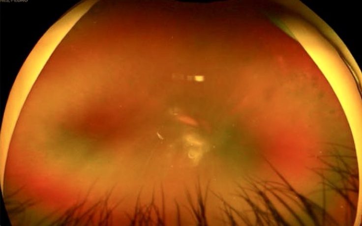 Tầm soát miễn phí bệnh võng mạc cho người bệnh đái tháo đường bằng công nghệ AI