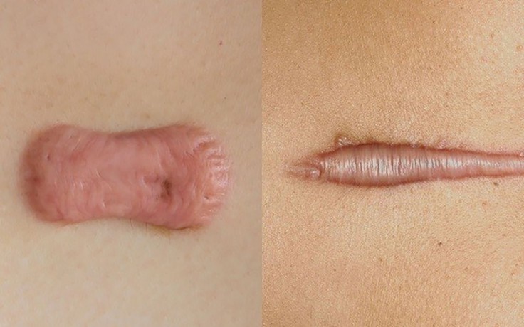 Scar FX & Rejuvasil khác gì so với các giải pháp chăm sóc sẹo thông thường?