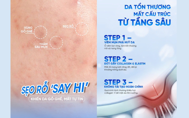 Đừng để sẹo mụn kéo lùi bạn, chăm da đẹp, tự tin trở lại, cơ hội đến