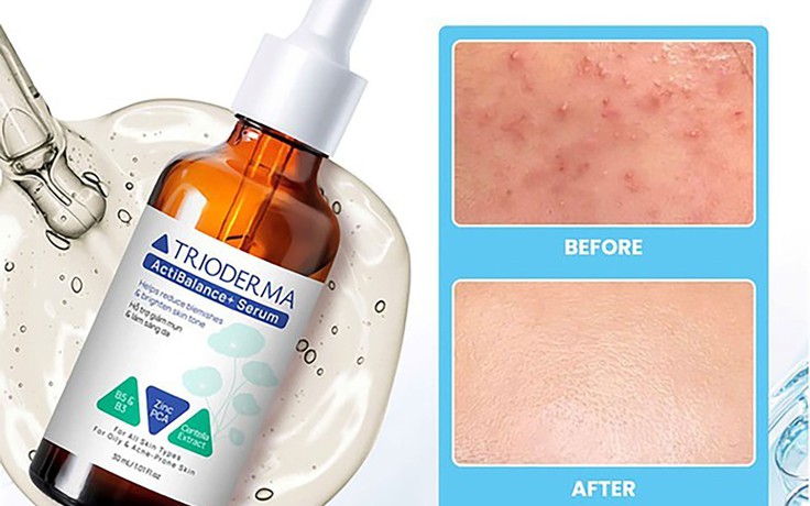 Hướng dẫn sử dụng serum giúp ngừa mụn Trioderma đúng chuẩn chuyên gia cho da khỏe đẹp