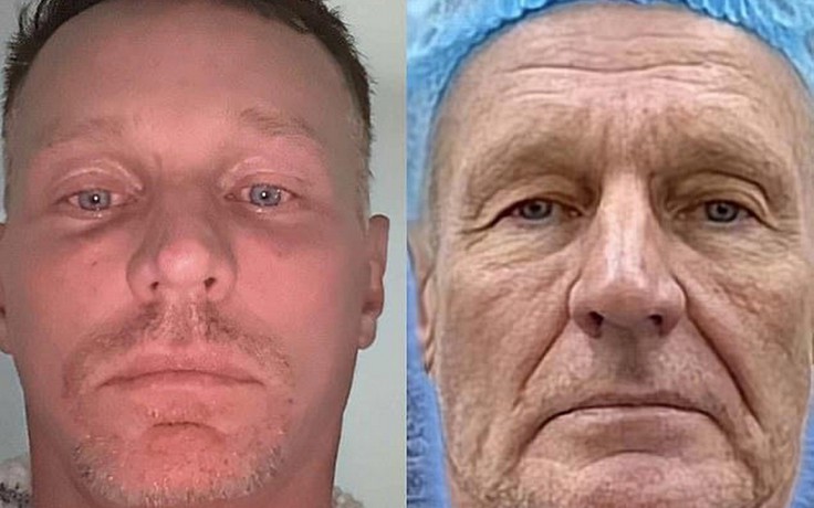 Người đàn ông Úc &#039;nổi như cồn&#039; sau khi đến Việt Nam phẫu thuật thẩm mỹ