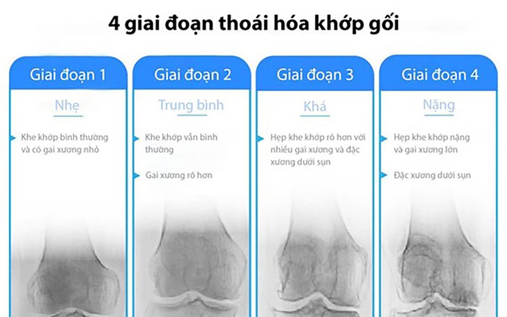 Cảnh báo: Lỡ giai đoạn vàng hồi sinh khớp gối, nhiều người gánh hệ lụy nghiêm trọng