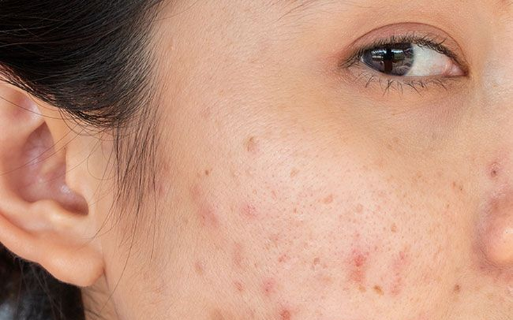 Cải thiện thâm mụn trong 4 tuần với một bước chăm da cuối cùng