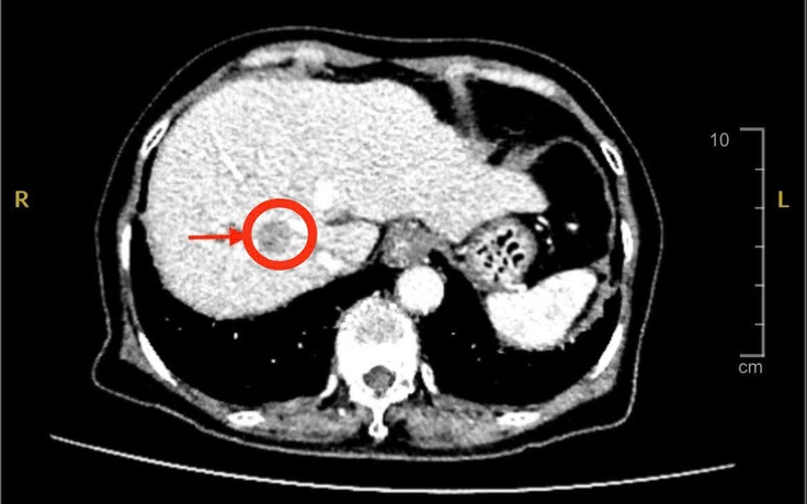 Đau bụng nhẹ, đi khám phát hiện ung thư gan